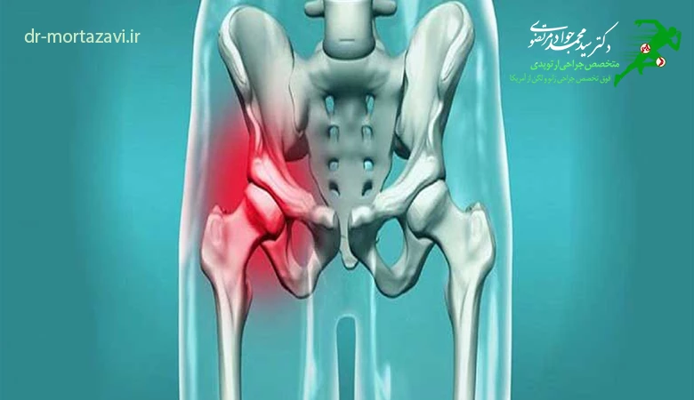 آناتومی مفصل لگن