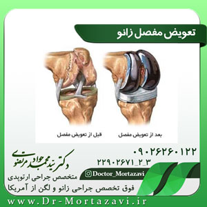 تعویض-مفصل-زانو