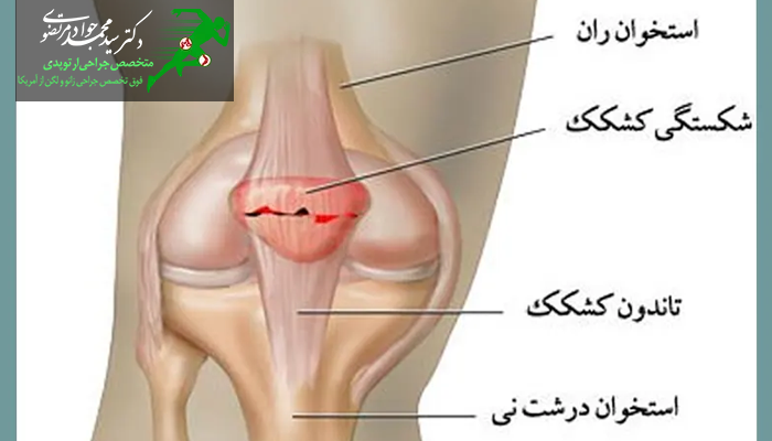 درمان شکستگی کشکک زانو