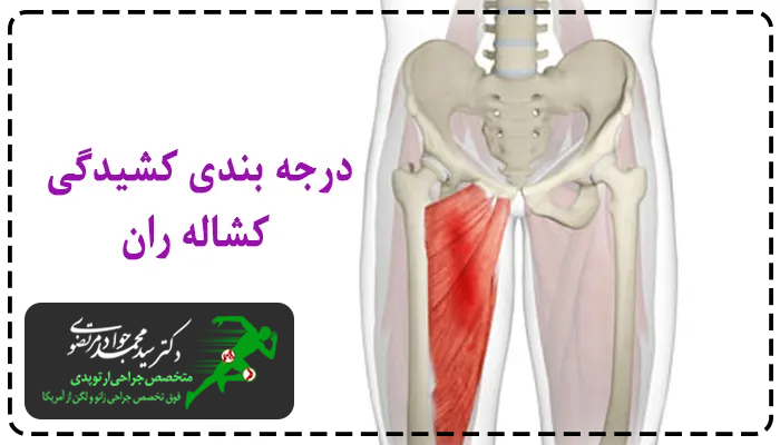 شدت کشیدگی کشاله ران