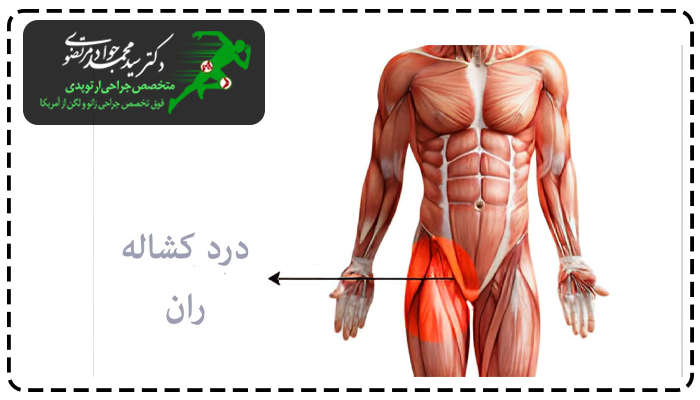کشیدگی کشاله ران چیست