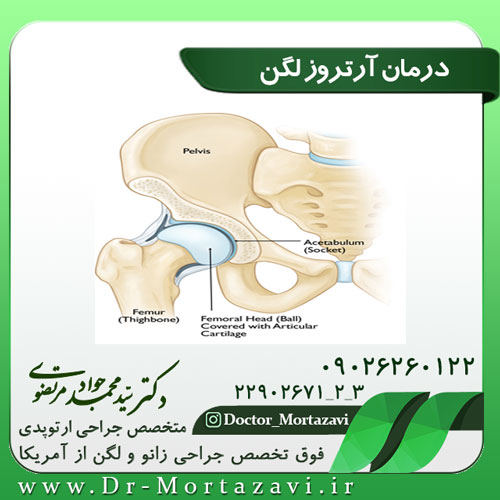 درمان آرتروز لگن