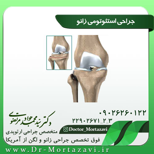 جراحی-استئوتومی-زانو