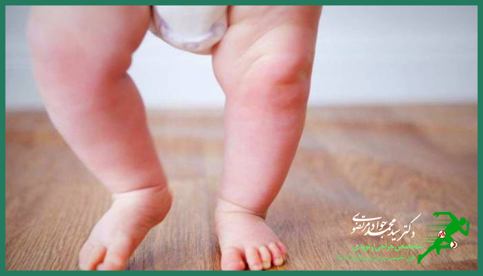 درمان پای پرانتزی در کودکان 