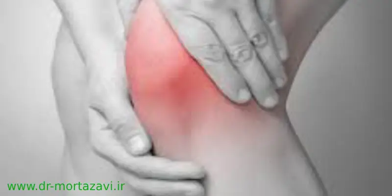 آیا پارگی رباط صلیبی نیاز به جراحی دارد؟