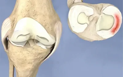درمان پارگی منیسک