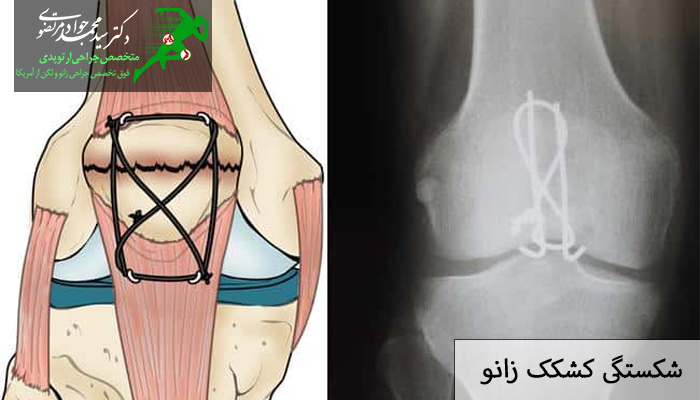 شکستگی کشکک زانو