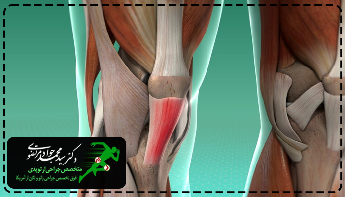 علائم تاندونیت زانو